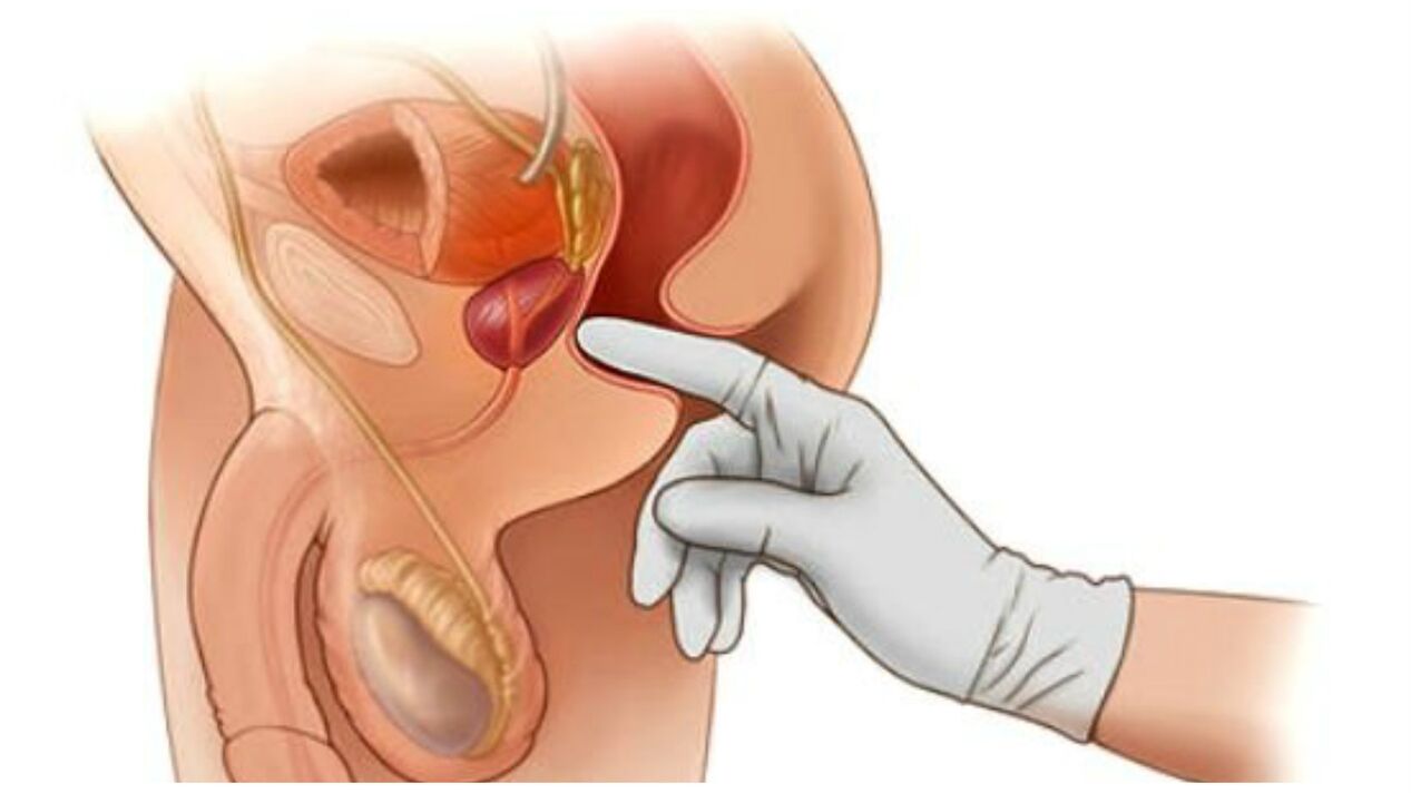 масаж на простатата при хроничен простатит