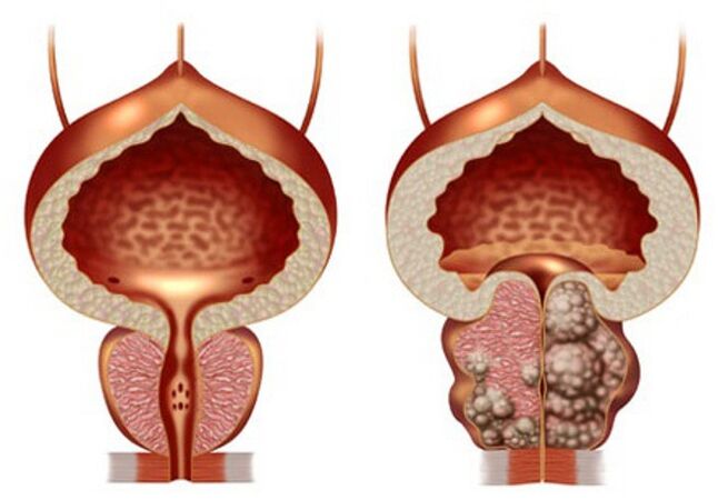 здрава простата и аденом на простатата