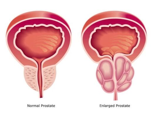 Нормална и увеличена простата