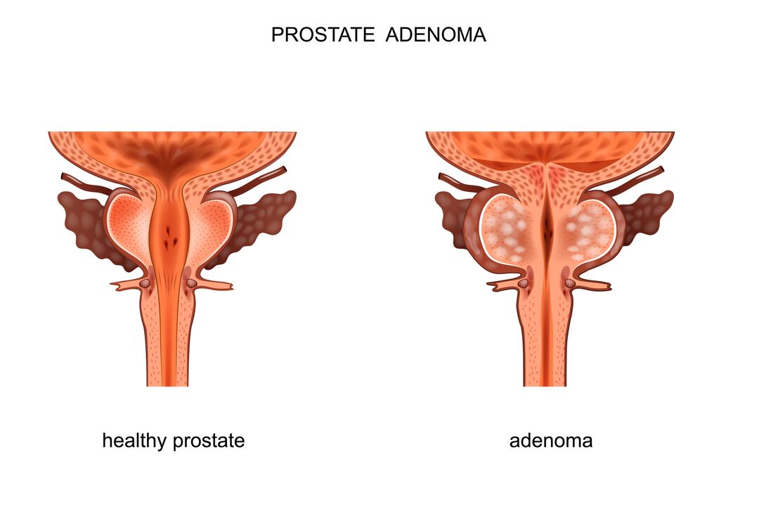 здрава простата и с аденом